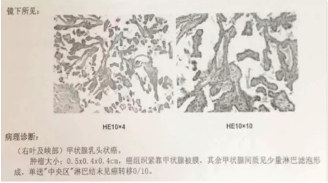別慌，甲狀腺疾病還可以這樣投保！