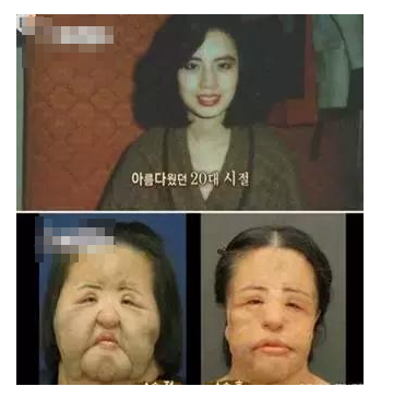 整容發(fā)生意外保險賠嗎？